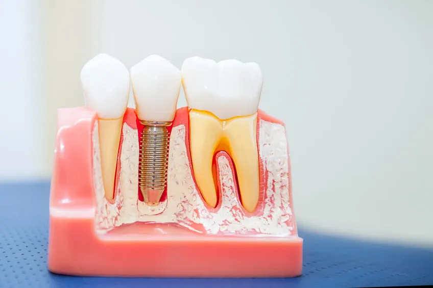 Dental Implant Process