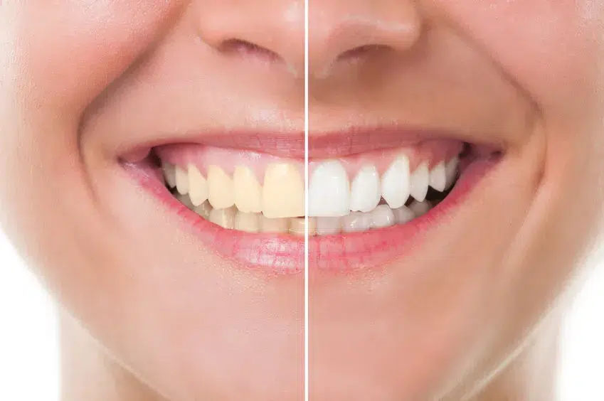 Teeth Whitening